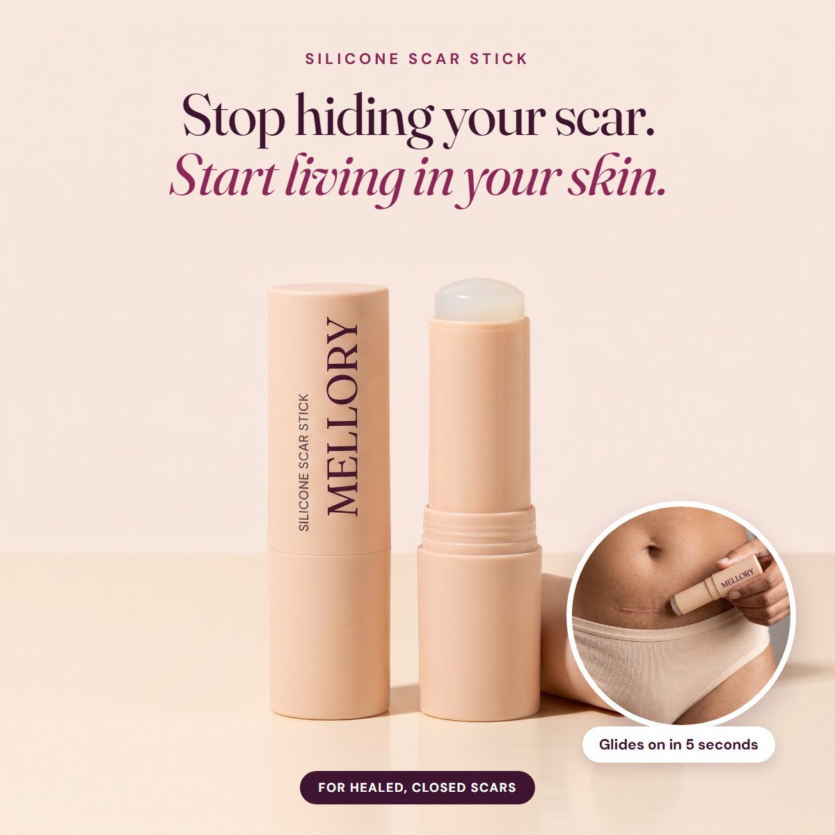 Mellory silicone scar stick, closed and open, with application on a C-section scar