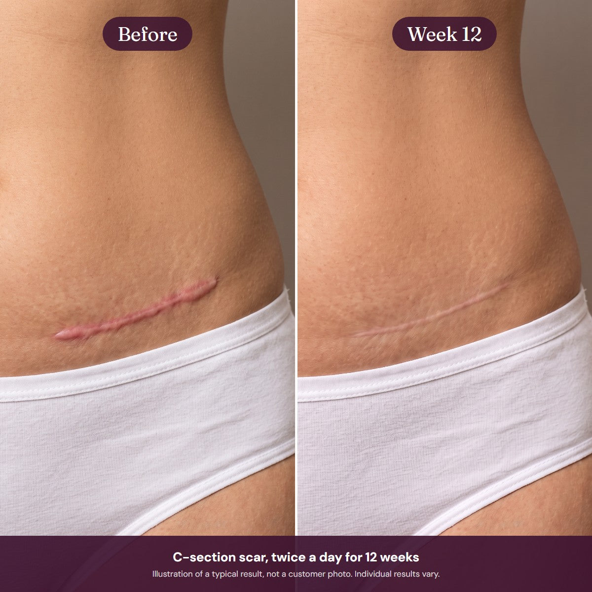 Illustration of a C-section scar before and after 12 weeks of silicone care