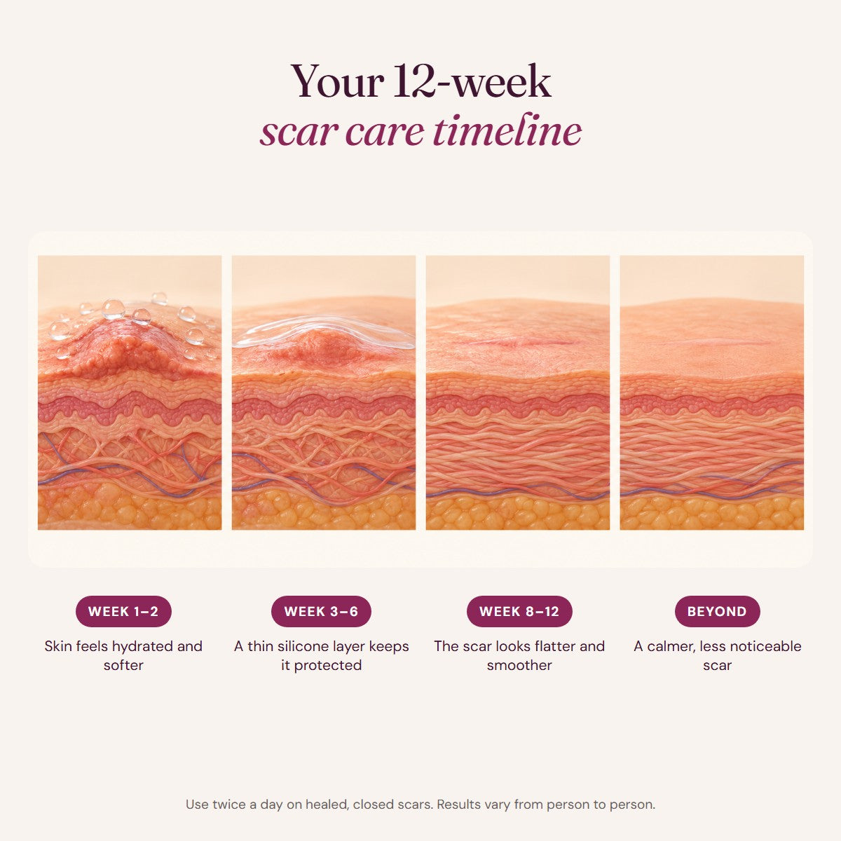 12-week scar care timeline with silicone